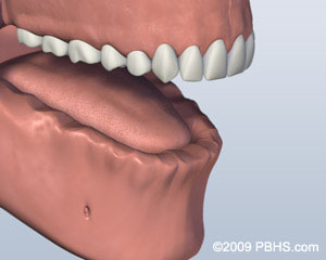 An illustration of implant retained dentures in the lower jaw.